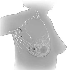 lumpectomy A lumpectomy is a breast-conserving surgery where the tumor is removed as well as some surrounding tissue. The axillary lymph nodes may also be removed.