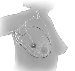 mastectomy A modified radical mastectomy removes the breast as well as axillary lymph nodes.